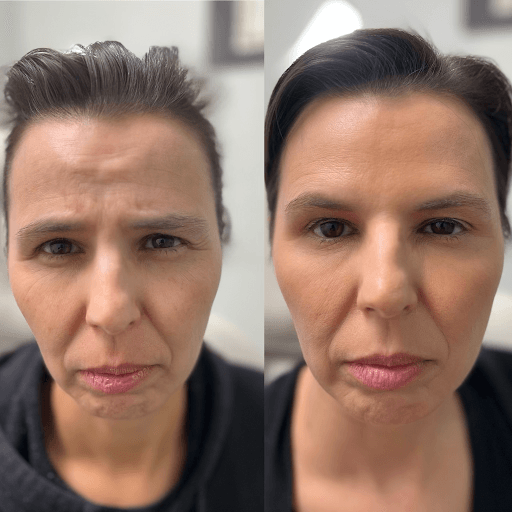 Botox Treatment Procedure Image