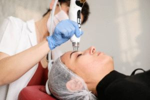 Melasma Laser Treatment