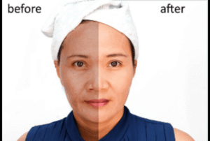Before and After Facial Balancing Results