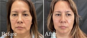 Sofwave Treatment