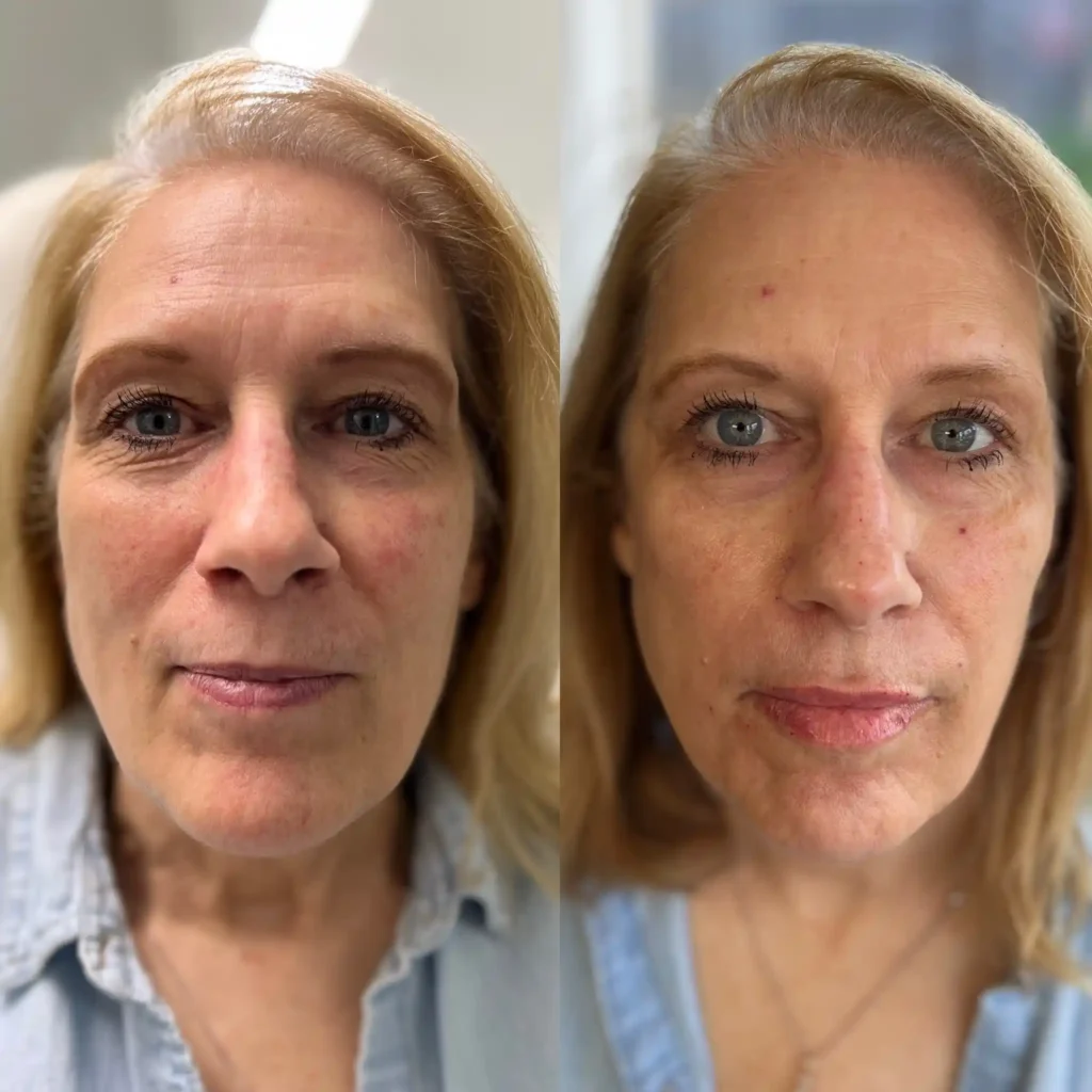 Facial balancing before and after result at Organic Skin Studio Sacramento