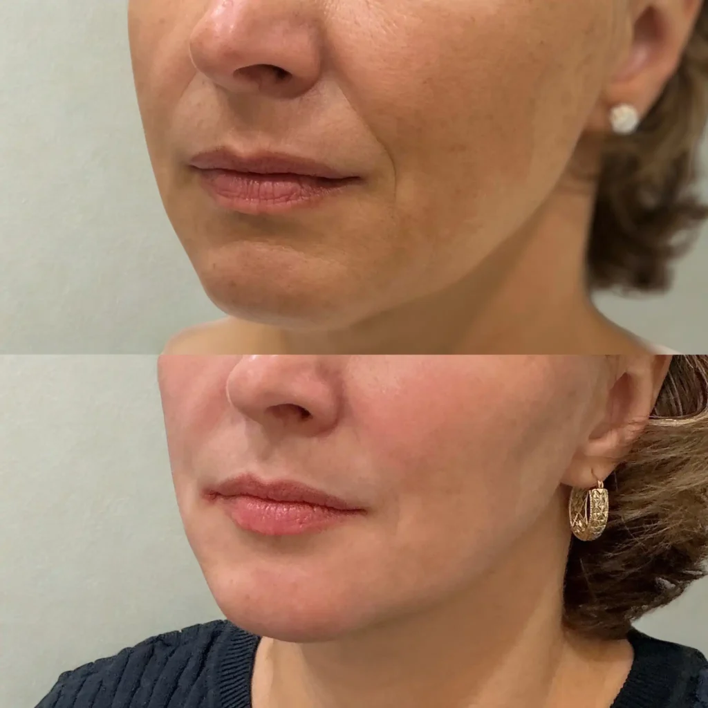 Facial balancing before and after result at Organic Skin Studio Sacramento